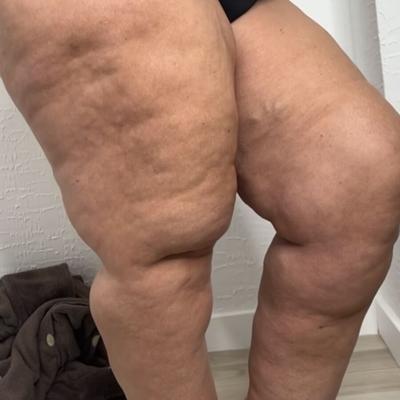 Ernsthafter Fettfetisch: BBW – The Lipedema Chronicles
