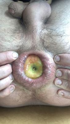 Culo anal manzana destruida puño douleur