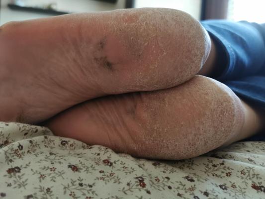 Моя мама ноги высыхают грубые призванные подошвы и каблуки